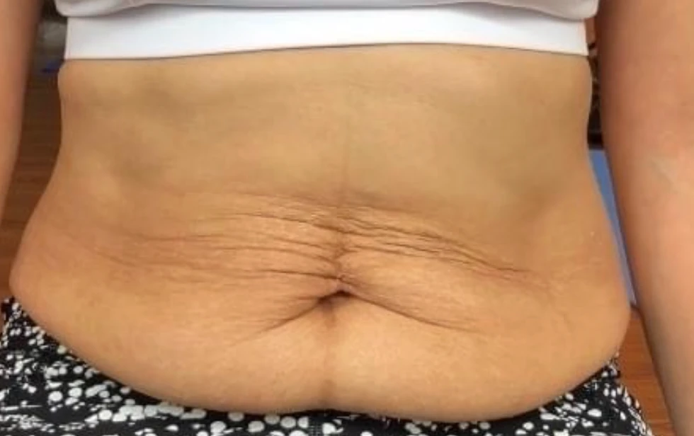 Real postpartum lower back and side skin folds