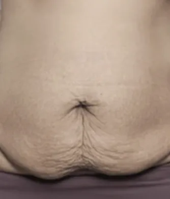 Black and white close-up of a real postpartum belly
