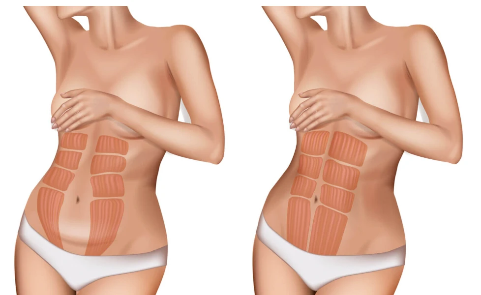 Diastasis Recti After a C-Section vs Vaginal Delivery, Is It Actually Different?
