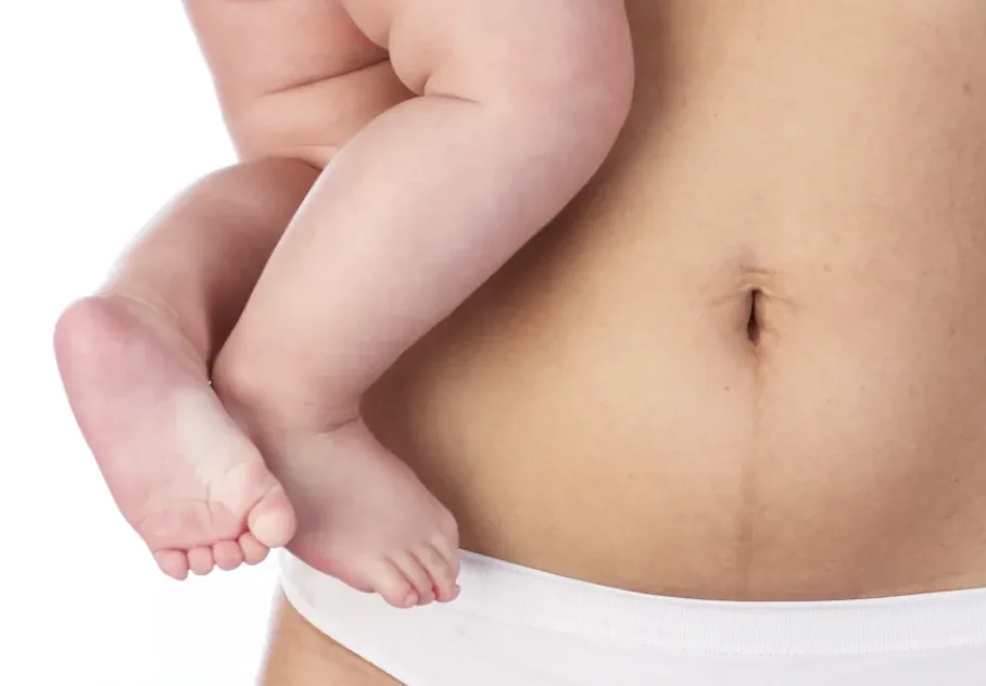 Weight Loss After a C-Section: What Actually Changes, and When